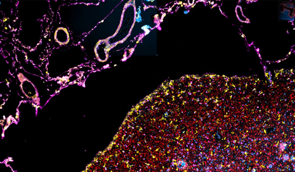 Closeup of the Ventricular area of the brain.